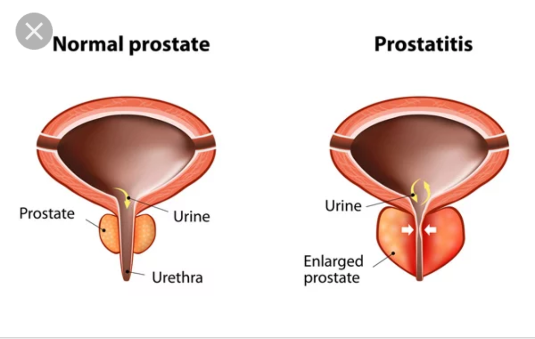 prostata infiammata prostatita afectează ejacularea?